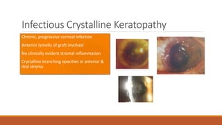 Infectious Crystalline Keratopathy
•Chronic, progressive corneal infection
•Anterior lamella of graft involved
•No clinically evident stromal inflammation
•Crystalline branching opacities in anterior &
mid stroma
 