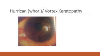 Hurrican (whorl)/ Vortex Keratopathy
 