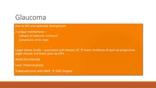 Glaucoma
•Due to PAS and epithelial downgrowth
•2 unique mechanisms –
Collapse of trabecular meshwork
Compression of AC angle
•Larger Donor Grafts – associated with deeper AC  lower incidence of post-op progressive
angle closure and lower post-op IOPs
•Avoid Dorzolamide
•Laser Trabeculoplasty
•Trabeculectomy with MMC  GDD Surgery
 