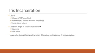 Iris Incarceration
• Causes
Collapse of AC/wound leak
Inflamed eyes/ Swollen & Flaccid Iris (preop)
Poorly placed sutures
• Closes AC angle at site incarceration 
Glaucoma
Graft failure
• Large adhesions at host-graft junction localized graft edema  vascularization
 