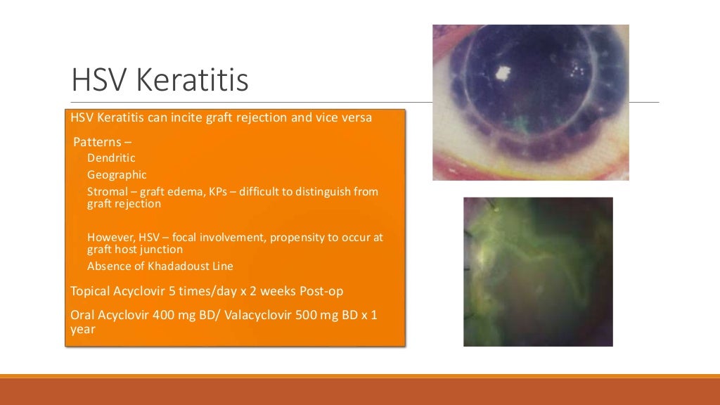 Keratoplasty associated complications