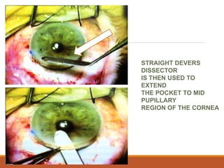 STRAIGHT DEVERS
DISSECTOR
IS THEN USED TO
EXTEND
THE POCKET TO MID
PUPILLARY
REGION OF THE CORNEA
 