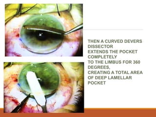 THEN A CURVED DEVERS
DISSECTOR
EXTENDS THE POCKET
COMPLETELY
TO THE LIMBUS FOR 360
DEGREES,
CREATING A TOTAL AREA
OF DEEP LAMELLAR
POCKET
 