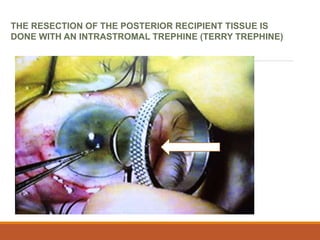 THE RESECTION OF THE POSTERIOR RECIPIENT TISSUE IS
DONE WITH AN INTRASTROMAL TREPHINE (TERRY TREPHINE)
 