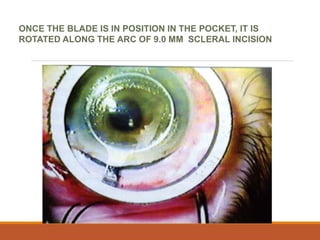 ONCE THE BLADE IS IN POSITION IN THE POCKET, IT IS
ROTATED ALONG THE ARC OF 9.0 MM SCLERAL INCISION
 