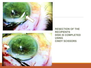 RESECTION OF THE
RECIPIENTS
DISK IS COMPLETED
USING
CINDY SCISSORS
 