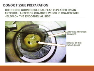 DONOR TISSUE PREPARATION
THE DONOR CORNEOSCLERAL FLAP IS PLACED ON AN
ARTIFICIAL ANTERIOR CHAMBER WHICH IS COATED WITH
HELON ON THE ENDOTHELIAL SIDE
ARTIFICIAL ANTERIOR
CHAMBER
HEALON ON THE
ENDOTHELIUM
 