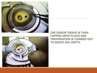 THE DONOR TISSUE IS THEN
CAPPED ONTO PLACE AND
TREPHINATION IS CARRIED OUT
TO ABOUT 60% DEPTH
 