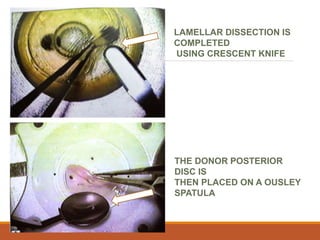 LAMELLAR DISSECTION IS
COMPLETED
USING CRESCENT KNIFE
THE DONOR POSTERIOR
DISC IS
THEN PLACED ON A OUSLEY
SPATULA
 