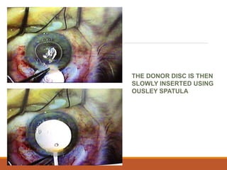 THE DONOR DISC IS THEN
SLOWLY INSERTED USING
OUSLEY SPATULA
 