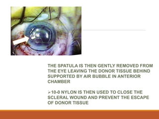 THE SPATULA IS THEN GENTLY REMOVED FROM
THE EYE LEAVING THE DONOR TISSUE BEHIND
SUPPORTED BY AIR BUBBLE IN ANTERIOR
CHAMBER
10-0 NYLON IS THEN USED TO CLOSE THE
SCLERAL WOUND AND PREVENT THE ESCAPE
OF DONOR TISSUE
 