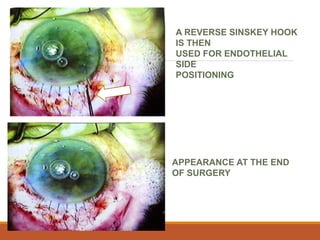 A REVERSE SINSKEY HOOK
IS THEN
USED FOR ENDOTHELIAL
SIDE
POSITIONING
APPEARANCE AT THE END
OF SURGERY
 