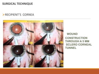 SURGICAL TECHNIQUE
RECIPIENT’S CORNEA
WOUND
CONSTRUCTION
THROUGH A 5 MM
SCLERO CORNEAL
TUNNEL
 
