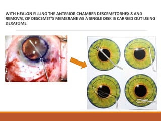 WITH HEALON FILLING THE ANTERIOR CHAMBER DESCEMETORHEXIS AND
REMOVAL OF DESCEMET’S MEMBRANE AS A SINGLE DISK IS CARRIED OUT USING
DEXATOME
 