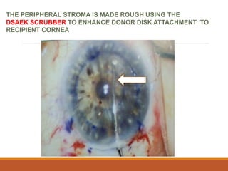 THE PERIPHERAL STROMA IS MADE ROUGH USING THE
DSAEK SCRUBBER TO ENHANCE DONOR DISK ATTACHMENT TO
RECIPIENT CORNEA
 