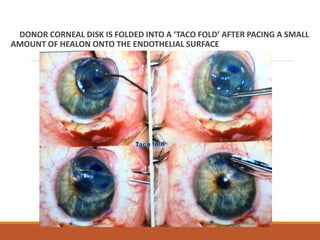 DONOR CORNEAL DISK IS FOLDED INTO A ‘TACO FOLD’ AFTER PACING A SMALL
AMOUNT OF HEALON ONTO THE ENDOTHELIAL SURFACE
 
