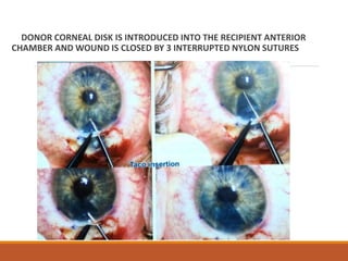 DONOR CORNEAL DISK IS INTRODUCED INTO THE RECIPIENT ANTERIOR
CHAMBER AND WOUND IS CLOSED BY 3 INTERRUPTED NYLON SUTURES
 