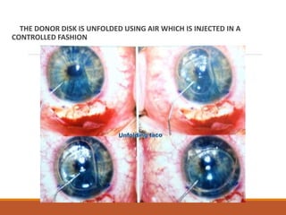 THE DONOR DISK IS UNFOLDED USING AIR WHICH IS INJECTED IN A
CONTROLLED FASHION
 