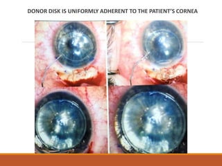 DONOR DISK IS UNIFORMLY ADHERENT TO THE PATIENT’S CORNEA
 