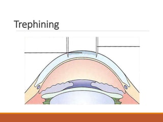 Trephining
 