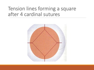 Tension lines forming a square
after 4 cardinal sutures
 