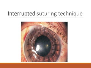 Interrupted suturing technique
 