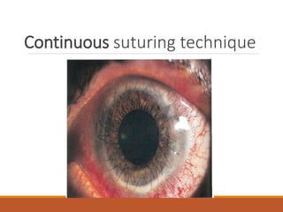 Continuous suturing technique
 
