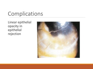 Complications
Linear epithelial
opacity in
epithelial
rejection
 