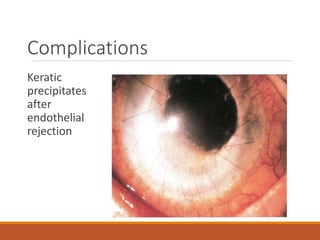 Complications
Keratic
precipitates
after
endothelial
rejection
 