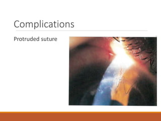 Complications
Protruded suture
 