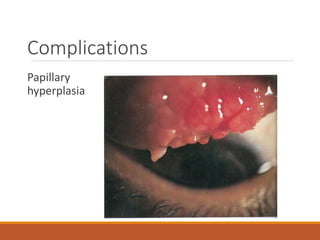 Complications
Papillary
hyperplasia
 
