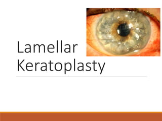 Lamellar
Keratoplasty
 