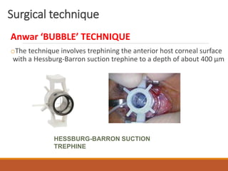 Surgical technique
Anwar ‘BUBBLE’ TECHNIQUE
oThe technique involves trephining the anterior host corneal surface
with a Hessburg-Barron suction trephine to a depth of about 400 µm
HESSBURG-BARRON SUCTION
TREPHINE
 