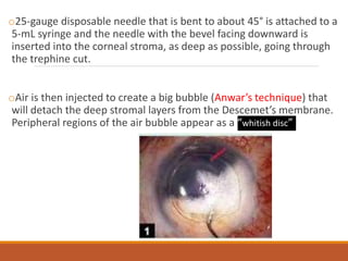 o25-gauge disposable needle that is bent to about 45° is attached to a
5-mL syringe and the needle with the bevel facing downward is
inserted into the corneal stroma, as deep as possible, going through
the trephine cut.
oAir is then injected to create a big bubble (Anwar’s technique) that
will detach the deep stromal layers from the Descemet’s membrane.
Peripheral regions of the air bubble appear as a “whitish disc”
 