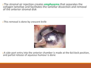 oThe stromal air injection creates emphysema that separates the
collagen lamellae and facilitates the lamellar dissection and removal
of the anterior stromal disk
oThis removal is done by crescent knife
oA side-port entry into the anterior chamber is made at the 6o’clock position,
and partial release of aqueous humour is done
 