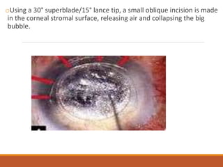 oUsing a 30° superblade/15° lance tip, a small oblique incision is made
in the corneal stromal surface, releasing air and collapsing the big
bubble.
 