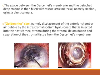 oThe space between the Descemet’s membrane and the detached
deep stroma is then filled with viscoelastic material, namely Healon ,
using a blunt cannula.
o“Golden ring” sign, namely displacement of the anterior chamber
air bubble by the intrastromal sodium hyaluronate that is injected
into the host corneal stroma during the stromal delamination and
separation of the stromal tissue from the Descemet’s membrane
 