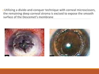 oUtilizing a divide-and-conquer technique with corneal microscissors,
the remaining deep corneal stroma is excised to expose the smooth
surface of the Descemet’s membrane
 