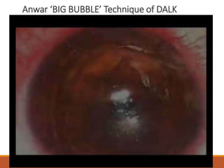 Anwar ‘BIG BUBBLE’ Technique of DALK
 