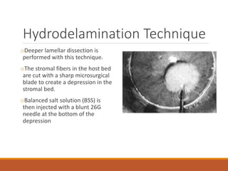Hydrodelamination Technique
oDeeper lamellar dissection is
performed with this technique.
oThe stromal fibers in the host bed
are cut with a sharp microsurgical
blade to create a depression in the
stromal bed.
oBalanced salt solution (BSS) is
then injected with a blunt 26G
needle at the bottom of the
depression
 
