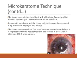 Microkeratome Technique
(contd…)
oThe donor cornea is then trephined with a Hessburg-Barron trephine,
followed by staining of the endothelium with trypan blue.
oDescemet’s membrane and the donor endothelium are then removed
using dry cellulose sponges and forceps.
oThe donor cornea devoid of Descemet’s membrane and endothelium is
then placed within the host corneal bed and sutured in place with 16
interrupted 10-0 nylon sutures.
 