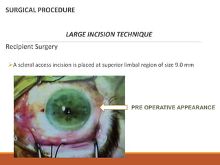 SURGICAL PROCEDURE
LARGE INCISION TECHNIQUE
Recipient Surgery
A scleral access incision is placed at superior limbal region of size 9.0 mm
PRE OPERATIVE APPEARANCE
 