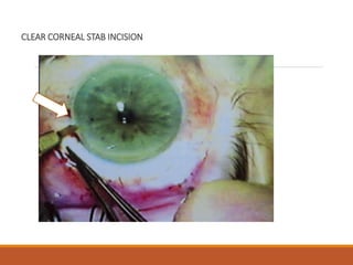 CLEAR CORNEAL STAB INCISION
 