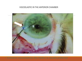 VISCOELASTIC IN THE ANTERIOR CHAMBER
 Cohesive viscoelasticsc like Healon is usually preferred
 