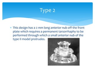  This design has a 2 mm long anterior nub off the front
plate which requires a permanent tarsorrhaphy to be
performed through which a small anterior nub of the
type II model protrudes.
Type 2
 