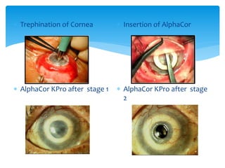  Trephination of Cornea
 AlphaCor KPro after stage 1
 Insertion of AlphaCor
 AlphaCor KPro after stage
2
 