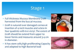  Full thickness Mucous Membrane Graft
harvested from the buccal mucosa.
 Graft is sutured over damaged cornea at
insertion of 4 recti muscles and sclera In
four quadrnts with 6-0 vicryl. The extent of
Graft should be extend from upper to
lower fornix and measures around 3-4 cm
in diameter.
 It has stem cells,high proliferating Capacity
and adapted to high Bacterial load
Stage 1
 