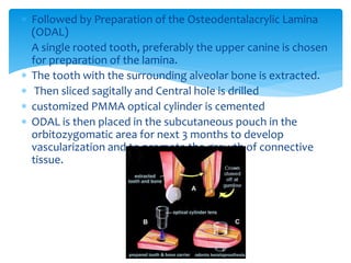  Followed by Preparation of the Osteodentalacrylic Lamina
(ODAL)
 A single rooted tooth, preferably the upper canine is chosen
for preparation of the lamina.
 The tooth with the surrounding alveolar bone is extracted.
 Then sliced sagitally and Central hole is drilled
 customized PMMA optical cylinder is cemented
 ODAL is then placed in the subcutaneous pouch in the
orbitozygomatic area for next 3 months to develop
vascularization and to promote the growth of connective
tissue.
 