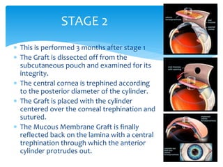  This is performed 3 months after stage 1
 The Graft is dissected off from the
subcutaneous pouch and examined for its
integrity.
 The central cornea is trephined according
to the posterior diameter of the cylinder.
 The Graft is placed with the cylinder
centered over the corneal trephination and
sutured.
 The Mucous Membrane Graft is finally
reflected back on the lamina with a central
trephination through which the anterior
cylinder protrudes out.
STAGE 2
 