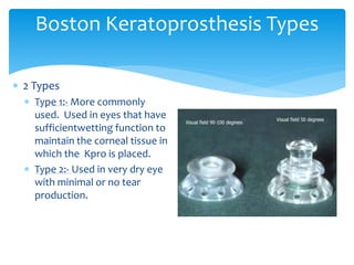 2 Types
 Type 1:- More commonly
used. Used in eyes that have
sufficientwetting function to
maintain the corneal tissue in
which the Kpro is placed.
 Type 2:- Used in very dry eye
with minimal or no tear
production.
Boston Keratoprosthesis Types
 
